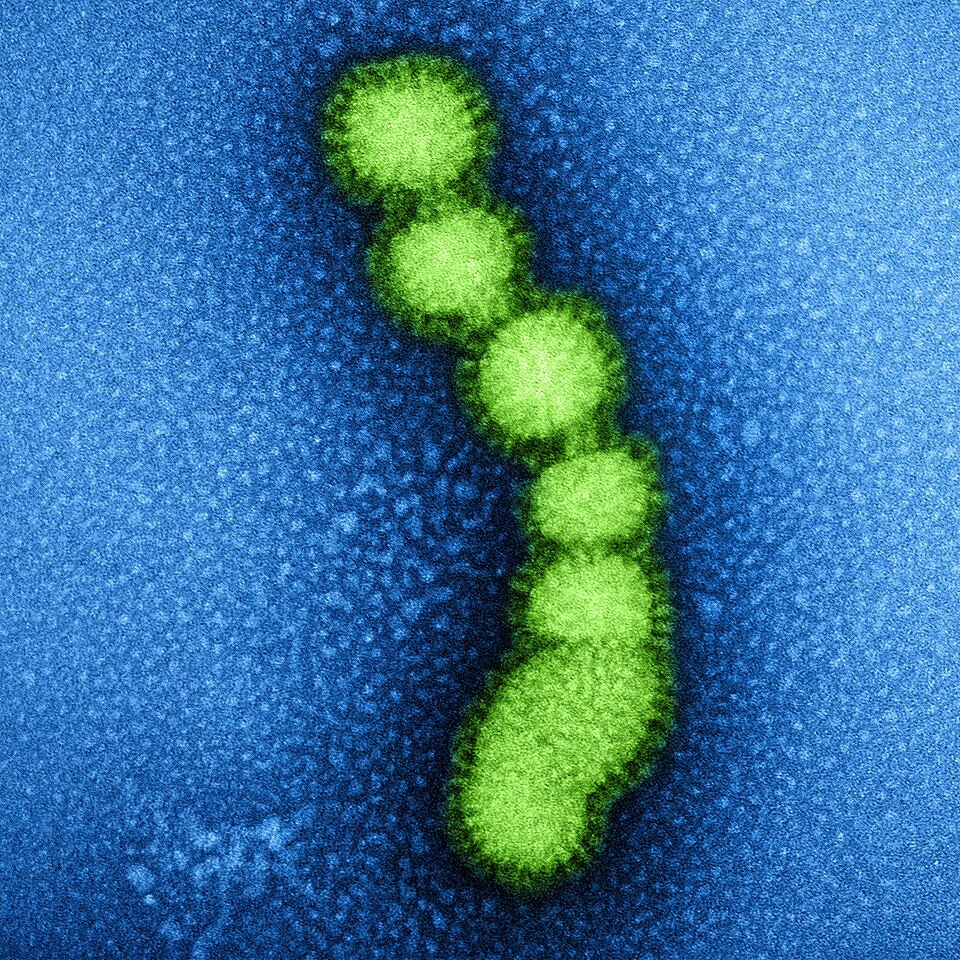 Punjab records 70 Swine Flu cases 